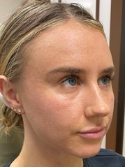 Dermal Fillers Before & After Gallery - Patient 20493236 - Image 1
