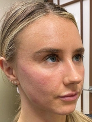 Dermal Fillers Before & After Gallery - Patient 20493236 - Image 2