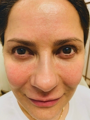 Dermal Fillers Before & After Gallery - Patient 20493237 - Image 1
