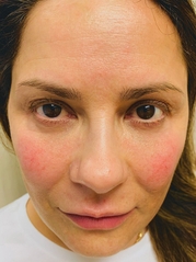 Dermal Fillers Before & After Gallery - Patient 20493237 - Image 2
