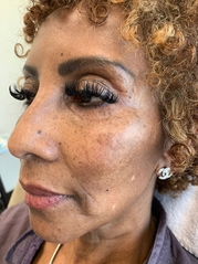 Dermal Fillers Before & After Gallery - Patient 20493238 - Image 1