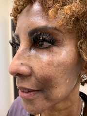 Dermal Fillers Before & After Gallery - Patient 20493238 - Image 2