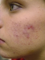 Acne Treatment Before & After Gallery - Patient 20493239 - Image 1