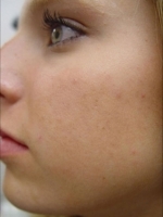 Acne Treatment Before & After Gallery - Patient 20493239 - Image 2