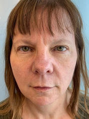 Dermal Fillers Before & After Gallery - Patient 20493240 - Image 1