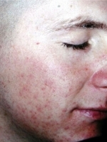 Acne Treatment Before & After Gallery - Patient 20493241 - Image 1