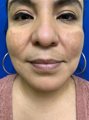 Dermal Fillers Before & After Gallery - Patient 20493242 - Image 1
