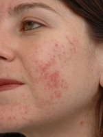 Acne Treatment Before & After Gallery - Patient 20493243 - Image 1