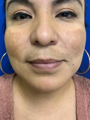 Dermal Fillers Before & After Gallery - Patient 20493242 - Image 2