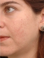 Acne Treatment Before & After Gallery - Patient 20493243 - Image 2
