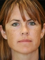 Cosmetic Dermatology Before & After Gallery - Patient 20493244 - Image 1