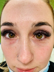 Dermal Fillers Before & After Gallery - Patient 20493245 - Image 1