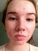 Acne Treatment Before & After Gallery - Patient 20493246 - Image 1