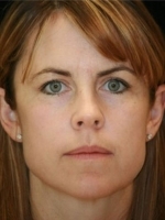 Cosmetic Dermatology Before & After Gallery - Patient 20493244 - Image 2