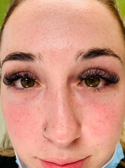 Dermal Fillers Before & After Gallery - Patient 20493245 - Image 2