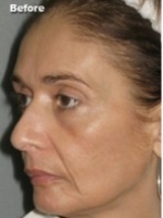 Dermal Fillers Before & After Gallery - Patient 20493249 - Image 1