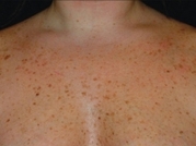 Cosmetic Dermatology Before & After Gallery - Patient 20493248 - Image 1