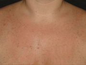 Cosmetic Dermatology Before & After Gallery - Patient 20493248 - Image 2