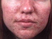 Acne Treatment Before & After Gallery - Patient 20493253 - Image 1