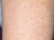 Cosmetic Dermatology Before & After Gallery - Patient 20493251 - Image 2