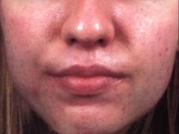 Acne Treatment Before & After Gallery - Patient 20493253 - Image 2