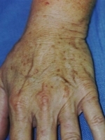 Cosmetic Dermatology Before & After Gallery - Patient 20493254 - Image 1