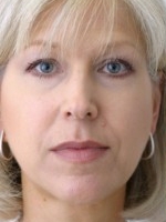 Dermal Fillers Before & After Gallery - Patient 20493255 - Image 1