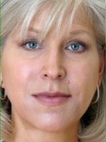 Dermal Fillers Before & After Gallery - Patient 20493255 - Image 2