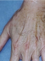 Cosmetic Dermatology Before & After Gallery - Patient 20493254 - Image 2