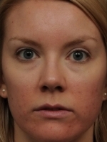 Acne Treatment Before & After Gallery - Patient 20493256 - Image 2