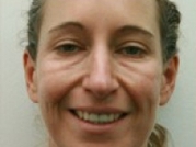 Dermal Fillers Before & After Gallery - Patient 20493258 - Image 1