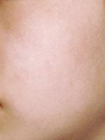 Cosmetic Dermatology Before & After Gallery - Patient 20493257 - Image 2