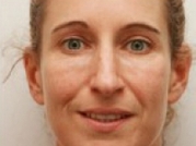 Dermal Fillers Before & After Gallery - Patient 20493258 - Image 2
