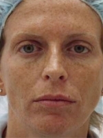 Cosmetic Dermatology Before & After Gallery - Patient 20493259 - Image 1