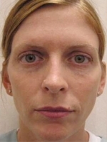 Cosmetic Dermatology Before & After Gallery - Patient 20493259 - Image 2