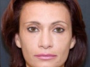 Dermal Fillers Before & After Gallery - Patient 20493260 - Image 2