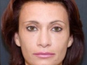 Dermal Fillers Before & After Gallery - Patient 20493260 - Image 2