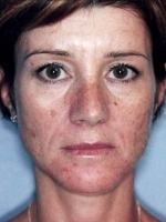 Cosmetic Dermatology Before & After Gallery - Patient 20493261 - Image 1