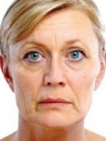 Dermal Fillers Before & After Gallery - Patient 20493262 - Image 1