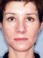 Cosmetic Dermatology Before & After Gallery - Patient 20493261 - Image 2