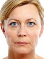 Dermal Fillers Before & After Gallery - Patient 20493262 - Image 2