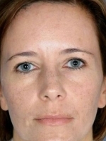 Cosmetic Dermatology Before & After Gallery - Patient 20493265 - Image 2