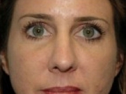 Dermal Fillers Before & After Gallery - Patient 20493266 - Image 2