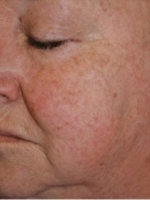 Cosmetic Dermatology Before & After Gallery - Patient 20493268 - Image 1