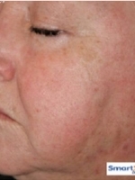 Cosmetic Dermatology Before & After Gallery - Patient 20493268 - Image 2