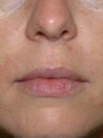Dermal Fillers Before & After Gallery - Patient 20493270 - Image 2