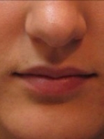 Dermal Fillers Before & After Gallery - Patient 20493272 - Image 1