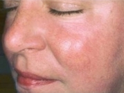 Cosmetic Dermatology Before & After Gallery - Patient 20493277 - Image 2