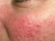Cosmetic Dermatology Before & After Gallery - Patient 20493279 - Image 1