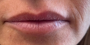 Lip Augmentation Before & After Gallery - Patient 20493280 - Image 1
